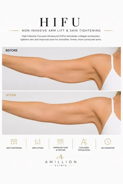 HIFU - Non-invasive arm lift: before and after treatment guide