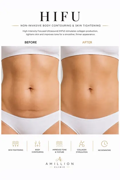 HIFU - Non-invasive body contouring: before and after treatment guide