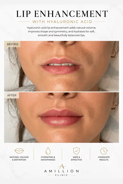 Lip Enhancement - With hyaluronic acid: before and after treatment guide