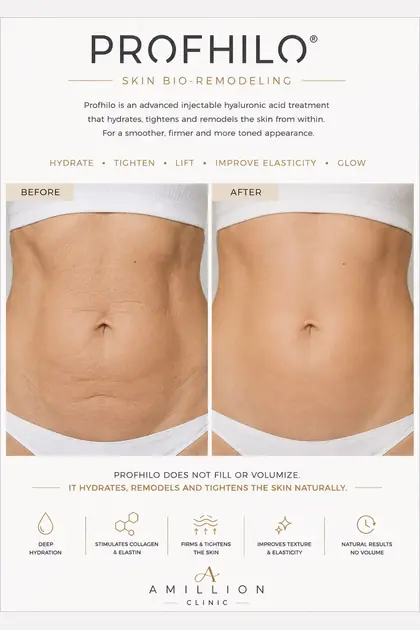 Profhilo® - Skin bio-remodeling — abdomen: before and after treatment guide