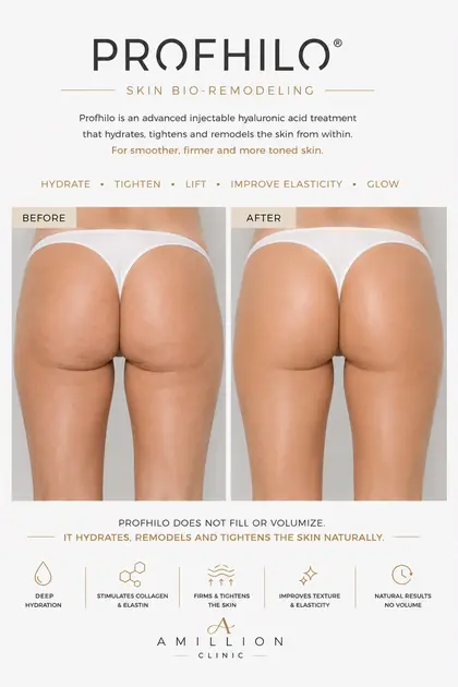 Profhilo® - Skin bio-remodeling — glutes: before and after treatment guide
