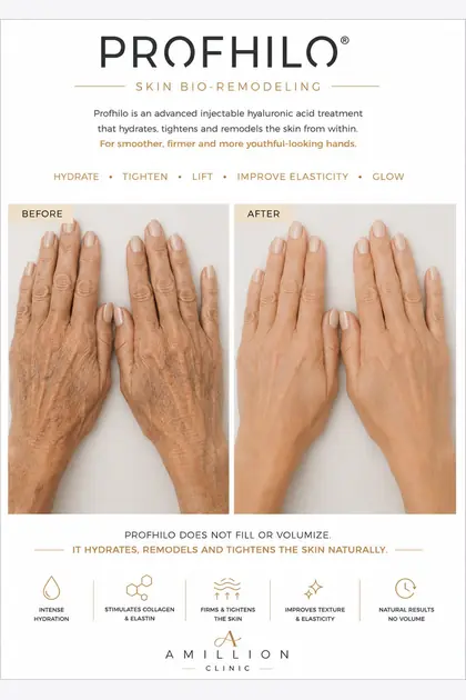 Profhilo® - Skin bio-remodeling — hands: before and after treatment guide