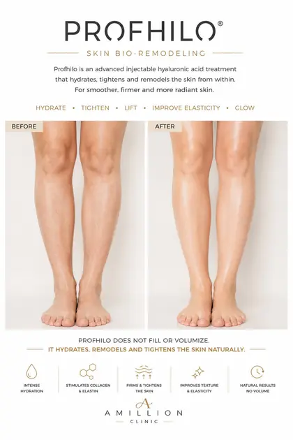 Profhilo® - Skin bio-remodeling — legs: before and after treatment guide