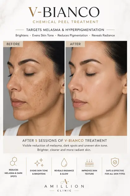 V-Bianco - Chemical peel treatment: before and after treatment guide
